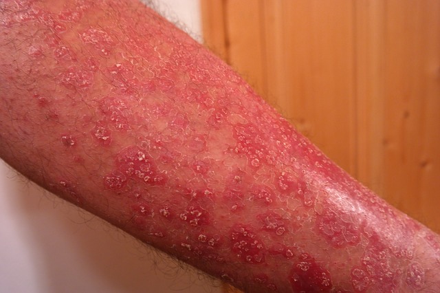 La dermatitis